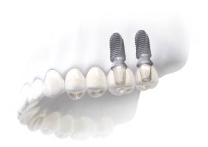임플란트 설명 이미지. ⓒ 덴티움