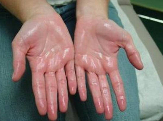 다른 사람보다 땀을 많이 흘리는 경우라면, 다한증인지 아닌지 검사를 받아볼 필요가 있어요. ⓒ 네이버 블로그