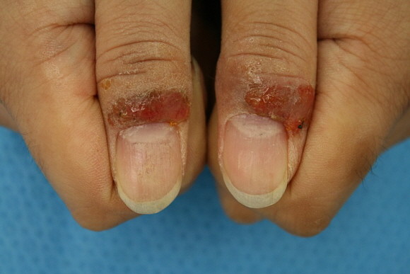 주부습진은 손에 생기는 습진 중 하나로, 심해질 경우 피부가 갈라지고 진물 또는 피가 배어 나오기도 한다. ⓒ 노원을지대학교병원