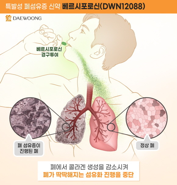 대웅제약은 세계 최초 신약으로 개발 중인 특발성 폐섬유증 후보물질 '베르시포로신'이 유럽의약품청으로부터 희귀의약품으로 추가 지정 받았다. © 대웅제약