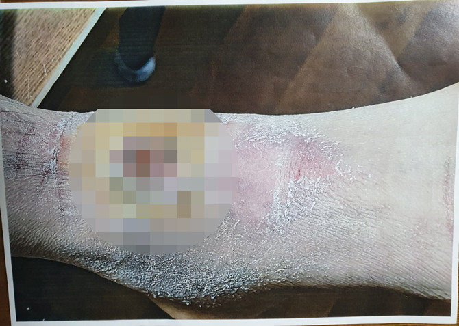 강 일병은 다리의 족저근막염이 '봉와직염'으로 악화돼 수슬을 진행, '비골신경계'가 손상됐다. ⓒ 프라임경제