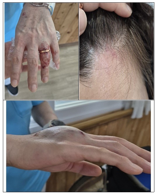 요양보호사가 효자손으로 맞은 상처들. = 김강석 기자